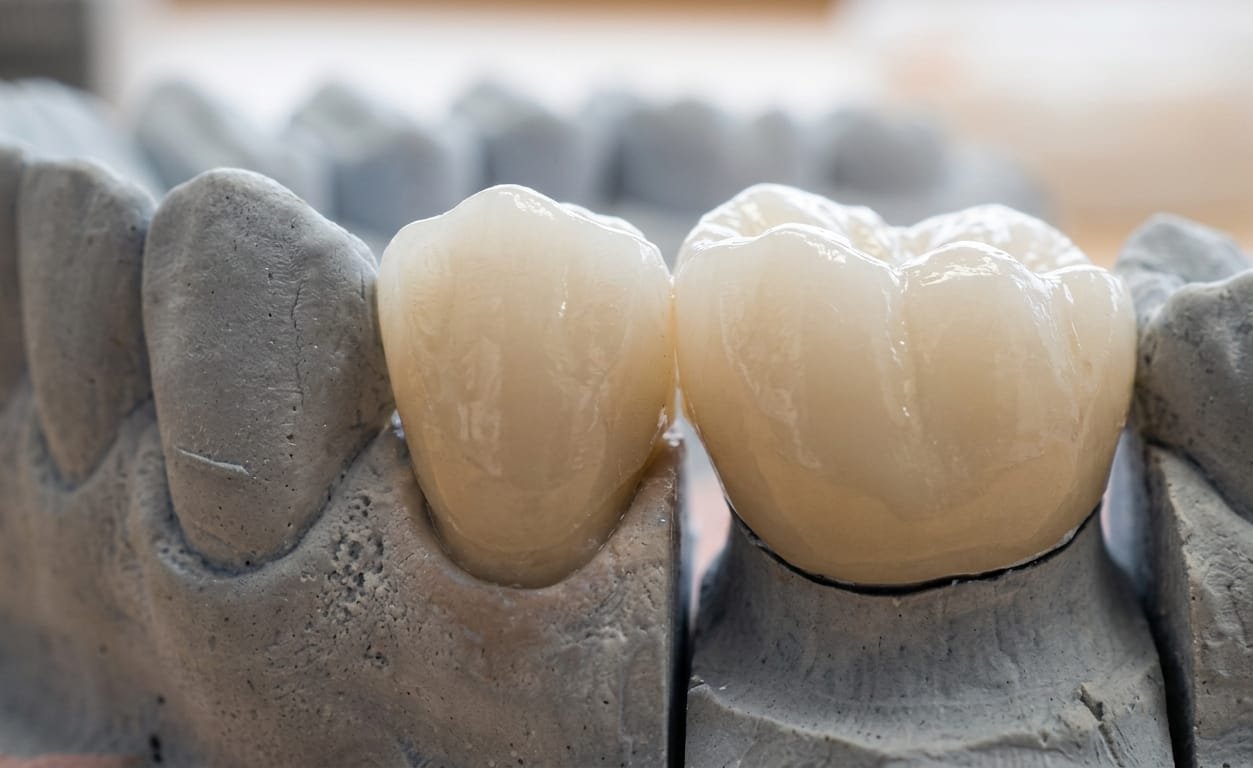 Coronas de porcelana dental